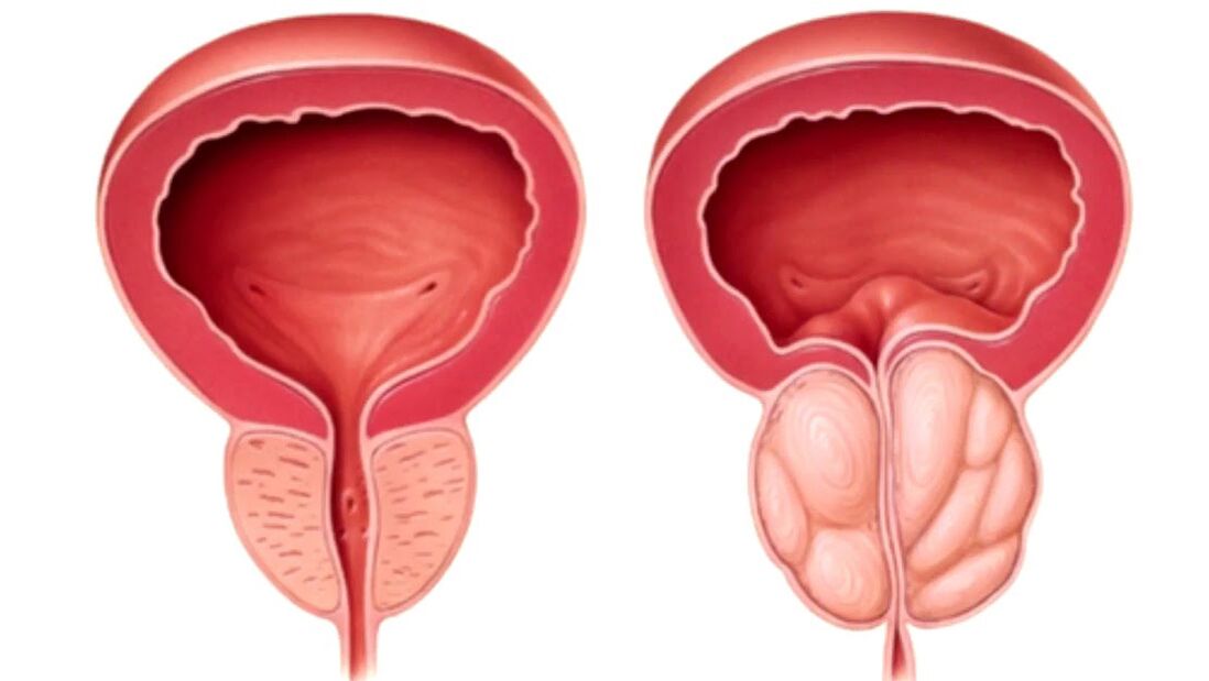 prostate saine et malade