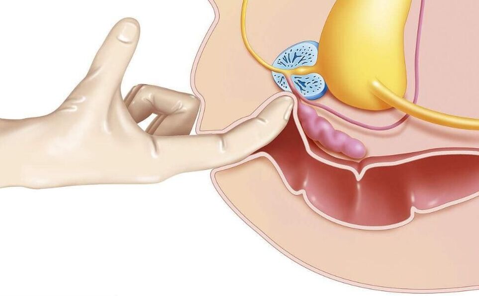 massage de la prostate pour le traitement de la prostatite