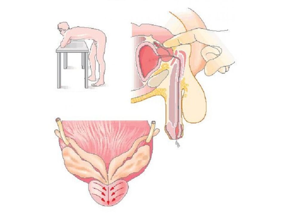 Technique de massage de la prostate réalisée par un médecin pour réaliser une analyse de la sécrétion. 